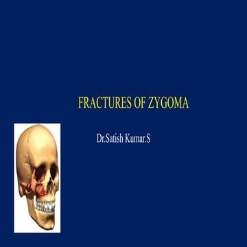 Zygoma fractures