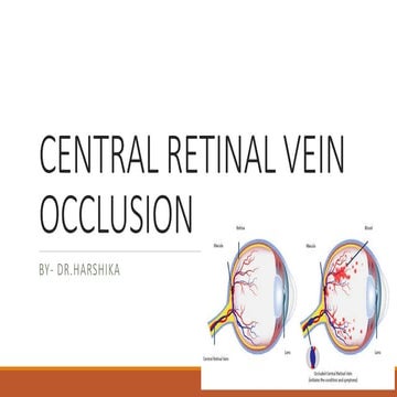 Central Retinal Vein Occlsion (CRVO) | PPT